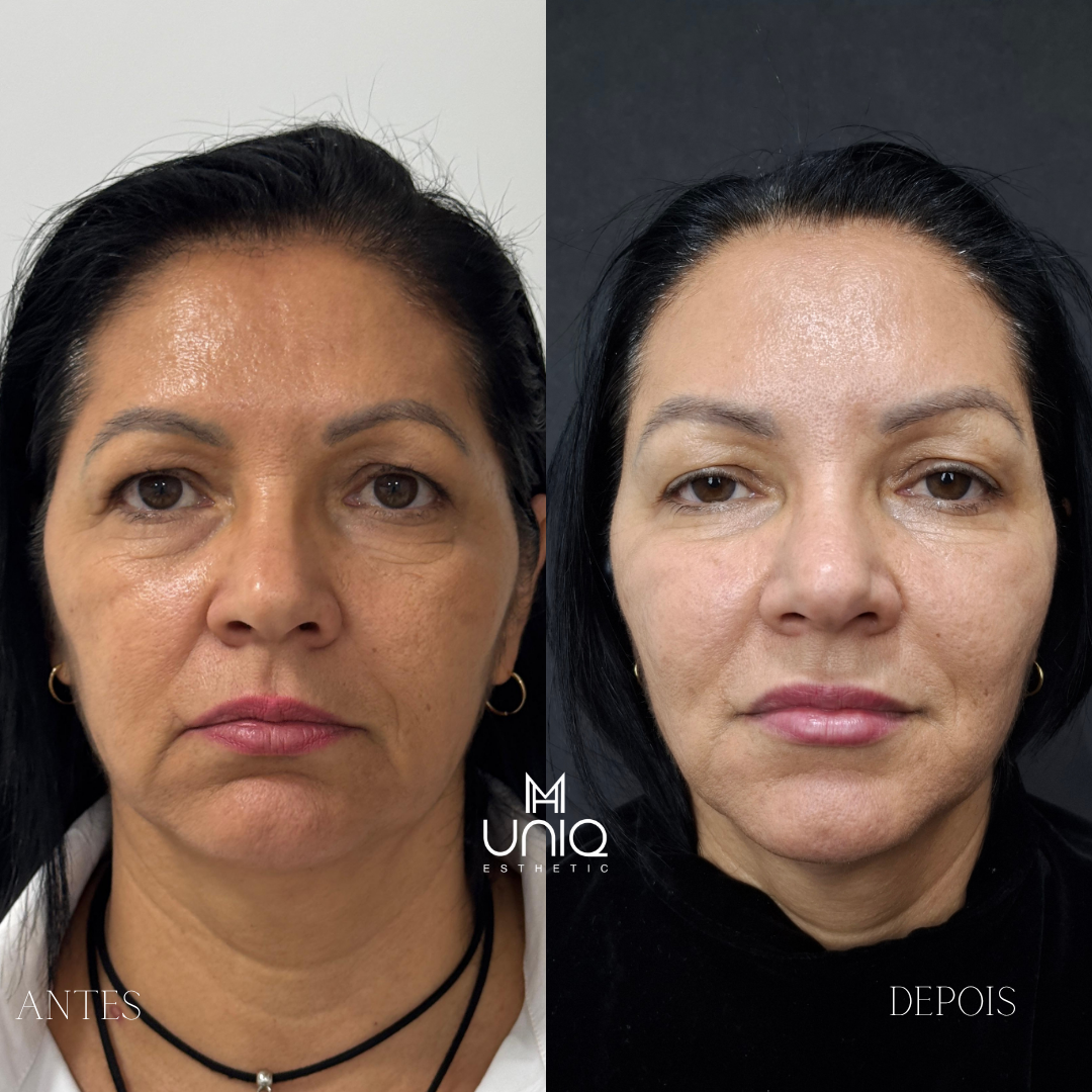 Before after minimal skincare Instagram post_20250723_094007_0000