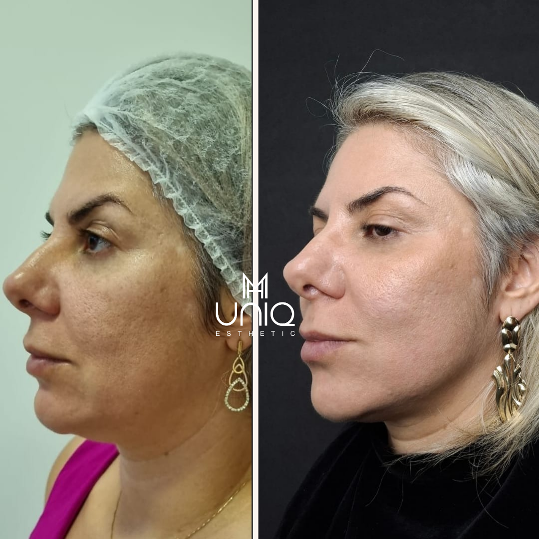 Before after minimal skincare Instagram post_20250811_153858_0000