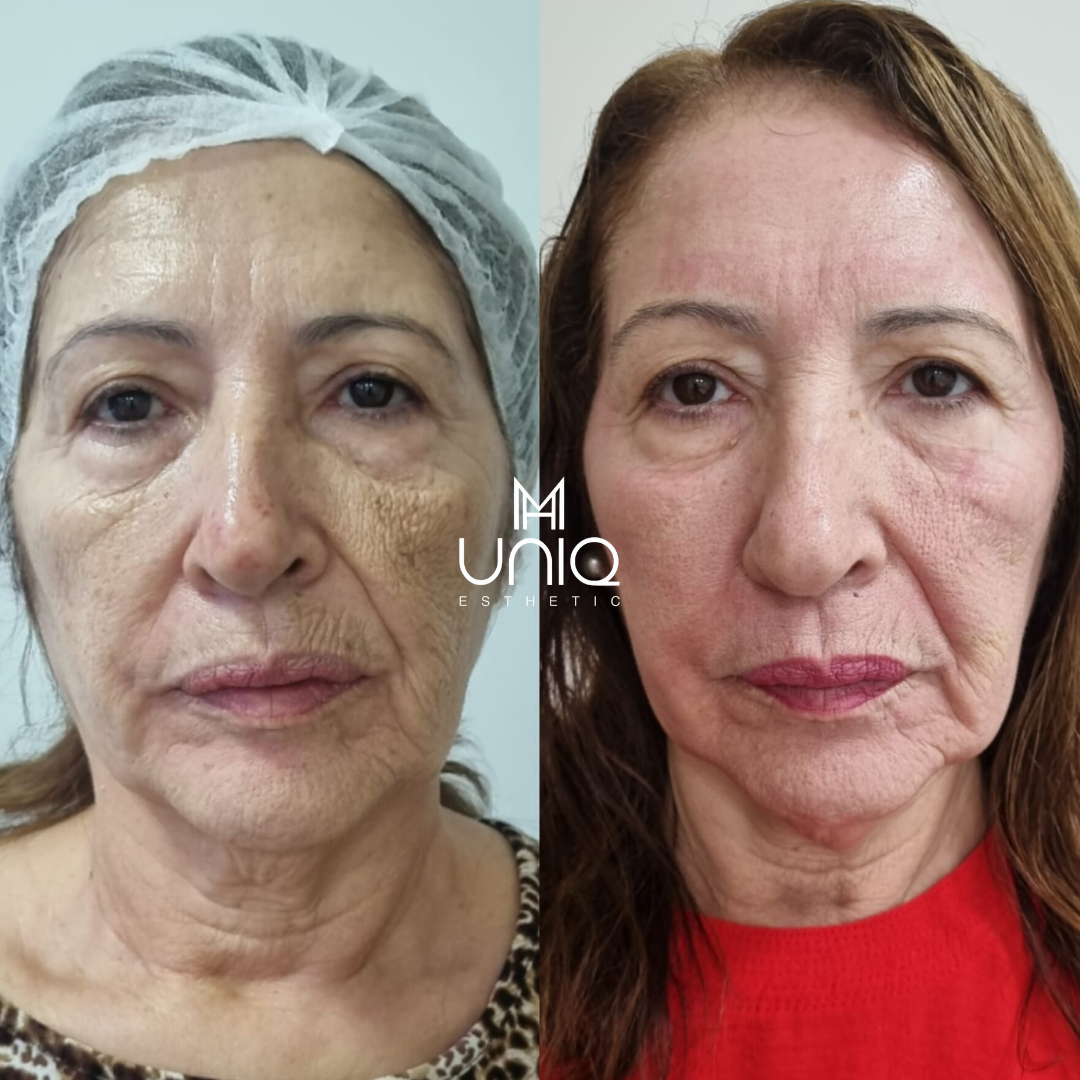 Beige Minimalist Skincare Before and After Instagram Post_20250606_104951_0000